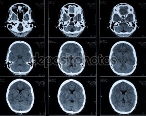 computer tomography CT photo of human brain